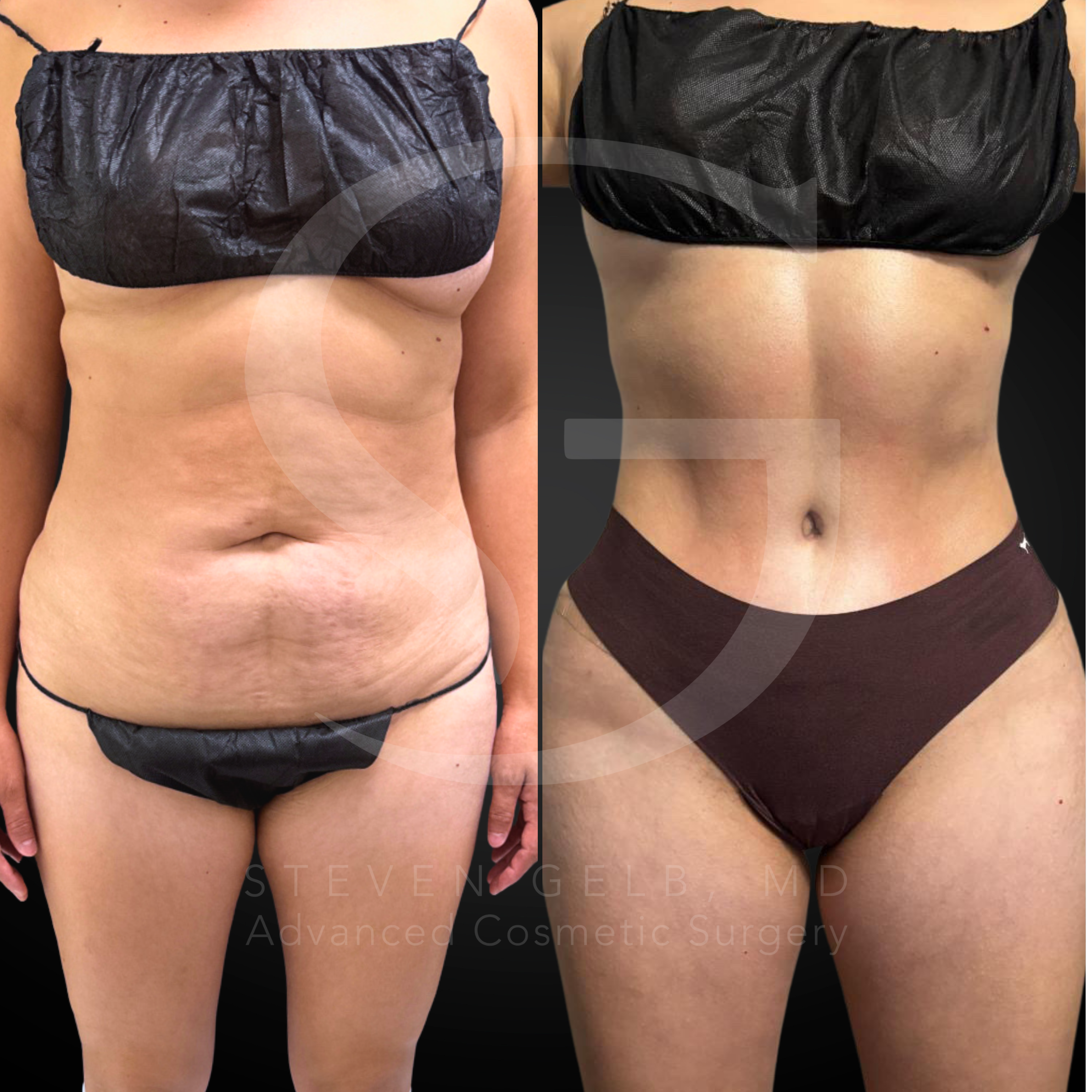 Body contouring with abdominoplasty, 41-year-old female, six months post-op.