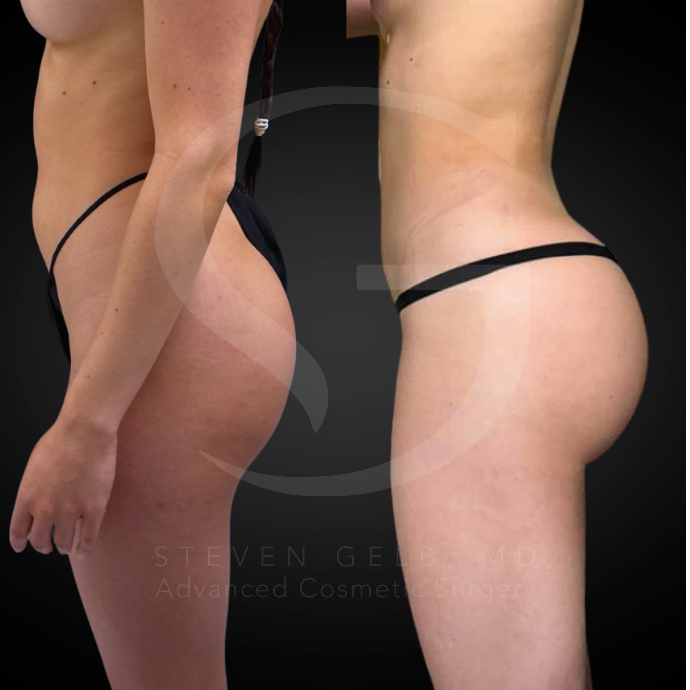 Brazilian Butt Lift result, 29-year-old female, five months post-op.