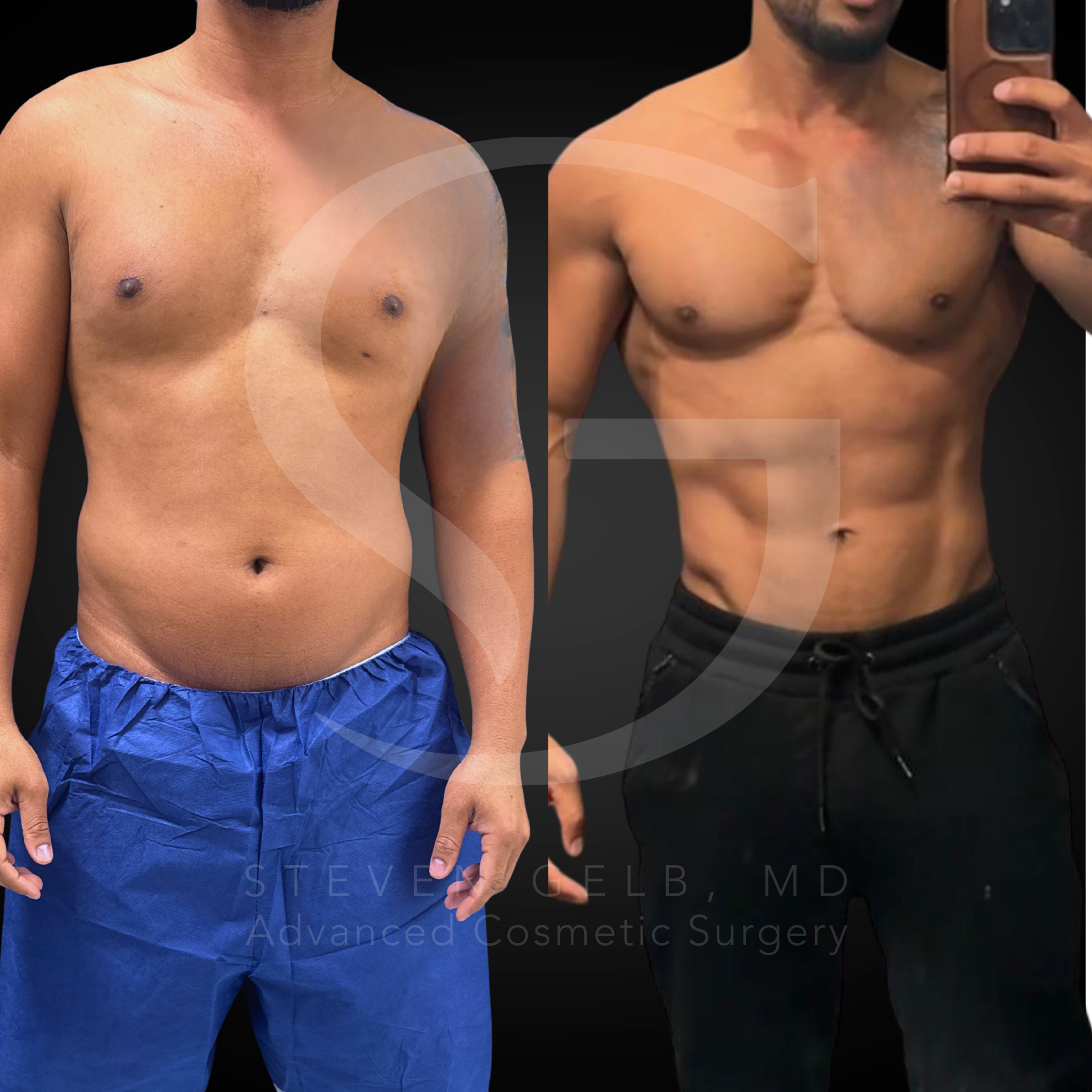 HD VASER Liposuction result, 35-year-old male, four months post-op.